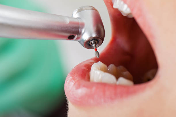 Best Emergency Wisdom Teeth Removal in Nephi, UT